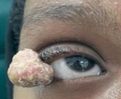 Giant eyelid molluscum contagiosum (a benign cutaneous viral infection) revealing an HIV infection in a 16-year-old Saudi girl from saudi girl