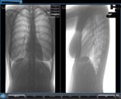Had to get an X-ray for my shortness of breathe and chest pain. Its been a rough week and wanted to know more about my X-ray. Im fascinated by medical stuff.(side boob oh no!) from swati nyudu fakes x ray