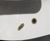 Hi. Just went to the toilet and had diahorrea. Not tarry, but definitely dark and so I&#39;m looking for medical specialist advice as to whether this is normal or a concern. Thanks. from macromastia medical
