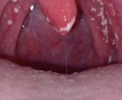 I have noticed small white dots on my throat what could it be, Ive read that some kind of infection, fungal, viral or bacterial. Ive searched for photos but they are different, Im thinking maybe thrush ? from bokep viral pijat mbah maryono 7