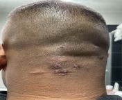 Partner has been getting these weird scabby like lesions on the back of his head. Impossible to get rid of. Doc has been using liquid nitrogen weekly to burn them and it did reduce for a bit but they are reoccurring. LITERALLY NEVER goes away completely.from buddy of mine has been swinging a hammer 10 longer than me so…40 never get too confident