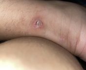 Does anyone have any advice for this stubborn wart? Its been 15 years, Ive gotten it frozen and lasered. Ive recently tried liquid wart remover and SA bandaids from achol akhe sex photosri and sa