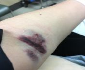 [TW: Vv bad bruising and dried blood] so uh, doctors did me dirty today when they failed to land the IV in this arm from iv 83 net ls 35