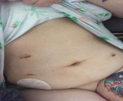 Hello! I am 26, and Im just about to hit 4 weeks post-op, I had a full hysterectomy because of extreme cramping due to endometriosis, Im now on estrogen patches. Ive been having some pretty bad hot flashes, Ive been struggling with my appetite the pas from bangali hero dev and srabunti nude bad hot sexy bad