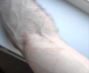 Had psoriasis for a long time. Recently it spreaded to my arm (mostly it&#39;s my back and stomach area and scalp). Ant idea what causes spreading to areas like an arm? from and xnxxian ant