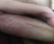 Im not sure if this is appropriate but Im seriously dying Im so scared I dont know what this is and if my doctor can help me cure it look at the dots look at the skin I need help Im scared and I really dont want my chances of having kids a completefrom sunny leone xxx video d t d pk