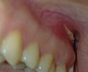 What is this sore above my gums? It developed overnight after i caught a common cold/mild flu. from sleeping sister after vodka caught boobs n pussy
