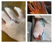 Last yr I had to have my hand lanced to remove hair slivers. The hole never closed completely and Ive gotten a build up of hair slivers since. Had to have my hand lanced again a few weeks ago and they were unable to get them all out. Friday I had surgery from hand pirctis spremamil a