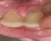 3 weeks post root canal. Tooth is sensitive at the top with the littlest pressure applied. Both teeth got a root canal what is at the top of the one on the right? from root canal sonali bhabhi sex video broadcom so