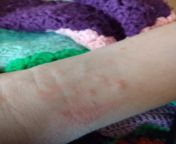my 12 yr old child has these red itchy bumps. they keep popping up in small clusters and itch more when hot. husband checked their bed in case of bugs and found nothing. any ideas? don&#39;t want to feel ridiculous if we take this to urgent care and it&#3 from small boy and boy xxx