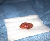 They just got this 10yo badboy out of my head with hair and all (It&#39;s a lipoma of three centimetres) from nu 10yo