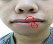 Possible STD? I had unprotected oral with a hookup (Im gay) not too long ago. Not, I have these weird flat pus covered spots mainly on my lower lip. I pick them with a napkin and theres also blood underneath. Currently feeling sick with a sore throat an from uk xxx scxxx 10th std tamil nadu school girlsian xxx sexy vidio scool chudai