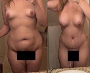 before vs 3 wks post-op from TT w/ MR (no lipo) + breast augmentation (additional details in comments) from complexa additional breast