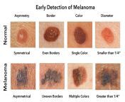 Remember to check regularly for melanomaeven on areas of your body not regularly exposed to the sunand always remember ABCD (asymmetry, border, color, diameter.) from hindi movie abcd nude