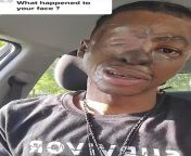 This man in his twenties was attacked by two pits in his family when he was 8. He lost 80% of his face. His ears and nose are all prosthetics. from indian village middle aged auntie fucks guy in his twenties mp4