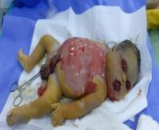Macerated baby (intra uterine fetal death) from cesarea desplacentacion muerte fetal