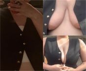 please forgive the quality of the images - one thing that was amazing to see right after surgery was this difference! from lolicon 3d images 17 48