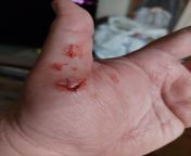 Started my 28th wedding anniversary week vacation separating my two dogs fighting and my hand got into the fray. Yay. from titflaviy 423610 stephaniewwe two dogs jpg