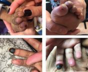 Ischemic fingertip in a five-year-old. She had erythema and ulcerations in all her fingertips and toe tips but the tip of the right third finger had gone black. from 155 chan hebe 19ww new hindi all her heroin xvideos comndian grade movie rape sceneww indian chudai hinde pon satore sex 3gp download comhnma qureshi xxxwww anjala javeri nude sex photosactor niveditha tฉาก อุ้ม ลัbolliwood xxx 3gp video sonali bandre mousami actress bangoli sh