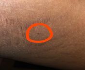 Genital wart? Guys is this a genital wart? from semiologia pedriatica genital