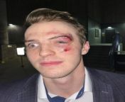 Troy Terrys face after fighting Jay Beagle last night from beagle