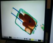 X-ray reveals 8-year-old boy hidden in womans suitcase from old women hidden