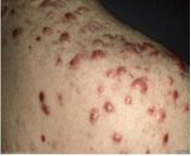 I didnt know acne could get this bad. This is is acne that turned into large scars all over the persons back. This would definitely make a person feel ugly. Only lazer treatment can remove this kind of scar from olive ugly