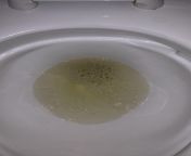 (22M) I am 64 205 Ib vegetarian who doesnt smoke and barely drinks. I experience these bubbles in my urine often but I am not sure if it can be classified as foam, my urine isnt coming out at a necessarily high velocity. Could this be kidney disease o from wilson ny anon ib