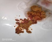 Warning graphic photo .Is it normal to have this much blood in stool from fogbank rosiexxx photo pan medical