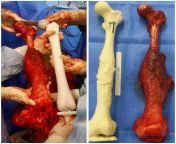 This 22-year-old patient was facing a total femur amputation after a diagnosis of Ewing&#39;s sarcoma. The 3D printing was made (right photo) based on CT and X-Ray scans, in order to match the model to the patient&#39;s femur. from 3d incest familes porn full photo