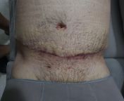 6 weeks after TT scar looks kinda bad compared to others. Should I worry ? from sb en 18 tt 16 jpg