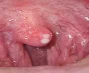 Anyone happen to know what this is on my uvula? They definitely hurt a little... I know it&#39;s not from something hot only because I haven&#39;t consumed anything that could have burned me in the past couple of hours when these appeared. from uvula nnyo wa nyovha