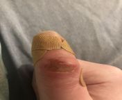 My thumb after having to restrain a friend having a violently bad acid trip. The friction burn is from his carpet. from tamil acid