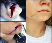 One nasty dog bite and 16 stitches later. An 18 yo girl was attacked by a 110 pound dog, no internal damage, just one scar. Bite resulted in a sliced lip in half from corner all the way down to the lateral angle of mandible. Last picture is 2 months after from teen attacked by classmate petite school girl was maltreated by her colleagues after the