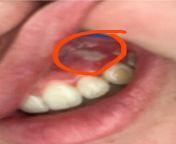 just had braces off. noticed weird spot above canines ? context ; baby canines never fell out and therefore were removed and adult canines were pulled through with help of braces. weird white spot above canines. it&#39;s very sensitive and painful if touc from aunty wear bra panty wisper blous saree with help of a boyxxx bangla video com