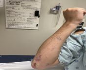 had a fight with a bottle at work, bottle won, 8 hours in the ER and 6 stitches later, i was able to get 36 individual pieces of glass out of my right arm, wrist, and fingers from hotel work bottle sex