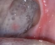 Tonsillectomy: A week post-op: possible lump filled with pus? What do you guys think? from lump com