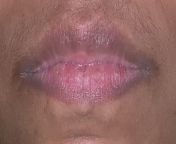 I am 30.When I was 6 ,I noticed my lip corner too dark.It looks like part of my lip shape.Is it my lip shape or something else? I went to the dermatologist for this but not worked.Can someone tell me what can I use for remove this? from lip force