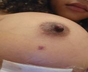 10 days post op and not getting lighter. Should I be concerned? from 10 www tamil nadu actress sex video vom downloadhamil sex mallu aunty 010 tamil actress hansi