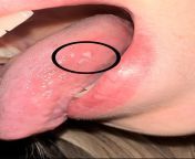 OHL or just Leukoplakia? ive had this appear several times over the past 6/7 years, no pain, negative HIV test, good overall oral hygiene. thoughts? from ohl zrlloqg