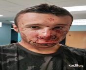 18 years old journalist disfigured by police. France needs your support, too. from france club