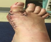 My foot after surgery, had to have my bones broken, pinned and plated, looked like a damn horror movie prop from top horror movie