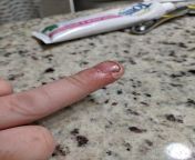 Sliced though fingertip at work. Got all the way through the nail but some skin held it on so no special treatment needed. from hentaied canela skin fucked all the way through