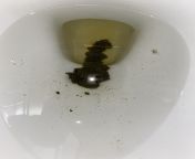 Very Dark green poop/Diarrhea. Stomach gurgling. Should I be worried? from girl stomach gurgling