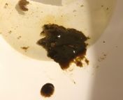 This was my poop right now. About a week ago I cut out unhealthy foods, Ive been eating less meat and processed foods, and I drank coffee on an empty stomach this morning. My poop has never looked like this before. It burnt while coming out too. from emirs foods