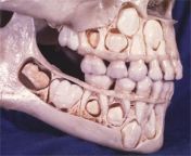 This is human toddler&#39;s skull. Turns out, toddlers adult teeth are underneath their eyes. Later on, they just pop into place when the baby teeth fall out. from toddler beastiality