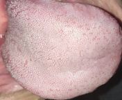 It&#39;s been quite sometime since i got this tongue problem. It causes me to have bad breath after eating. What can I do to improve this condition? from pretended to have bad erection
