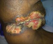 Herpes in an Indian patient with HIV/AIDS from indian arati with sanjay