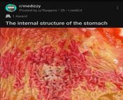 Saw this on medizzy this morning. Edited it so you can see the internal structure of an IBS stomach from ibs s