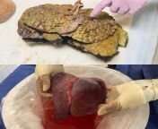 Ran into this today. The liver of CF patient and his new donate liver. Talked to the OP a bit, he is several months post-op and doing well. Like with lung transplants, new his liver is not effected by his CF. from patient and docto